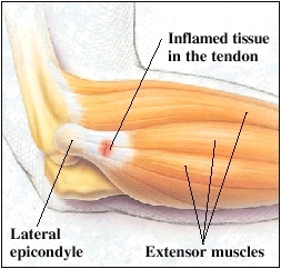 Tennis Elbow Illustration