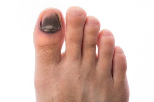 Nail Infection, Fungal (Onychomycosis) Condition, Treatments and Pictures  for Teens - Skinsight